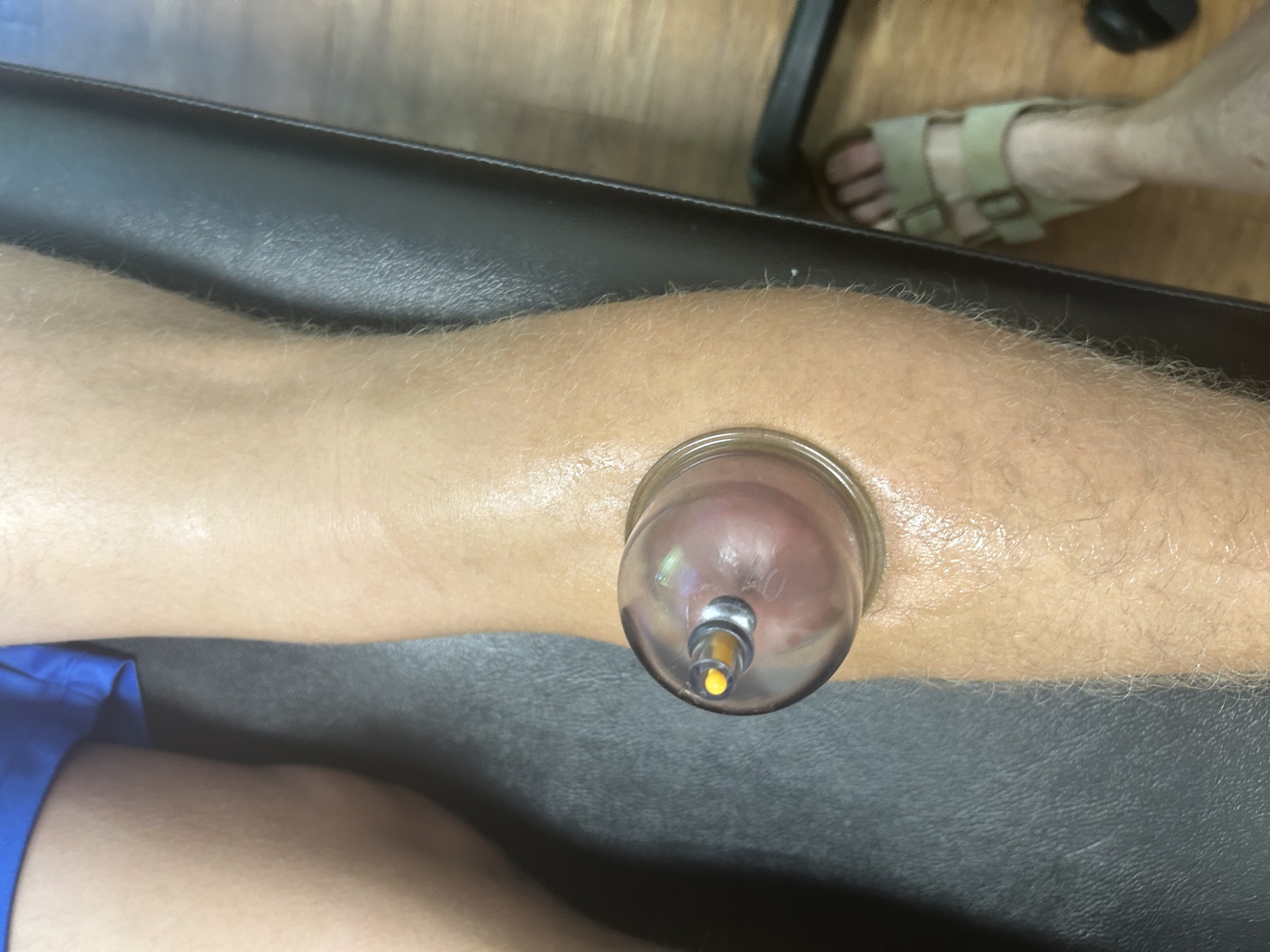 Myofascial cupping placed on the lateral calf at Marin Joint Health